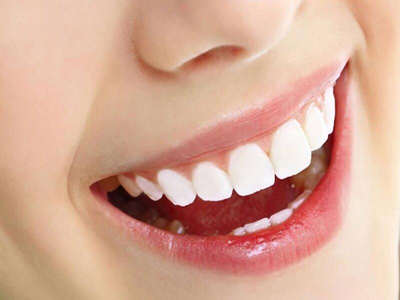 Các lưu ý liên quan đến bảo hành răng sứ  