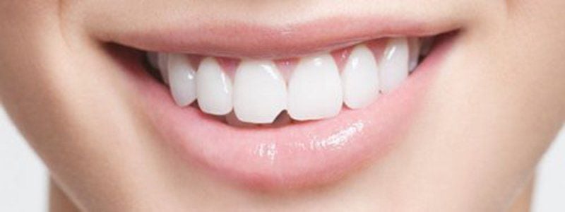 Răng sứ bị mẻ gây mất thẩm mỹ và ảnh hưởng đến việc ăn uống của bạn
