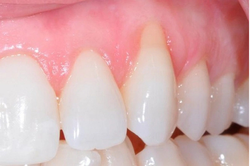 Phần nướu và răng có khe hở khiến thức ăn thường bị mắc vào
