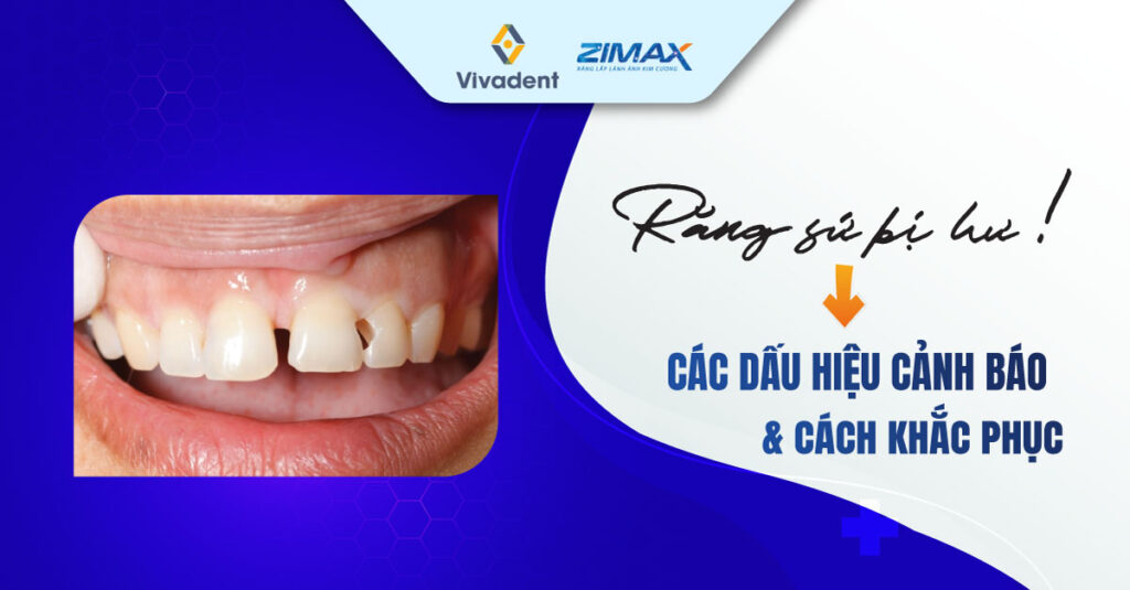 Dấu hiệu răng sứ bị hư: Các dấu hiệu cảnh báo và cách khắc phục