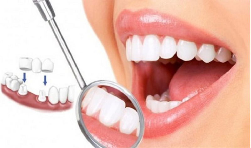 Lựa chọn loại răng sứ có chất lượng tốt thực hiện tại địa chỉ nha khoa uy tín giúp hạn chế các sự cố xảy ra