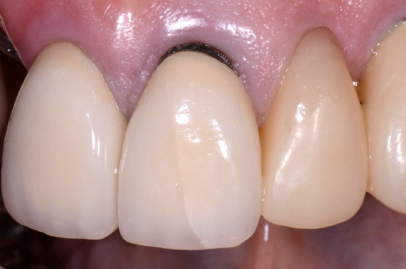 Răng sứ bị đen chân răng là do sử dụng chất liệu mão sứ có chứa kim loại