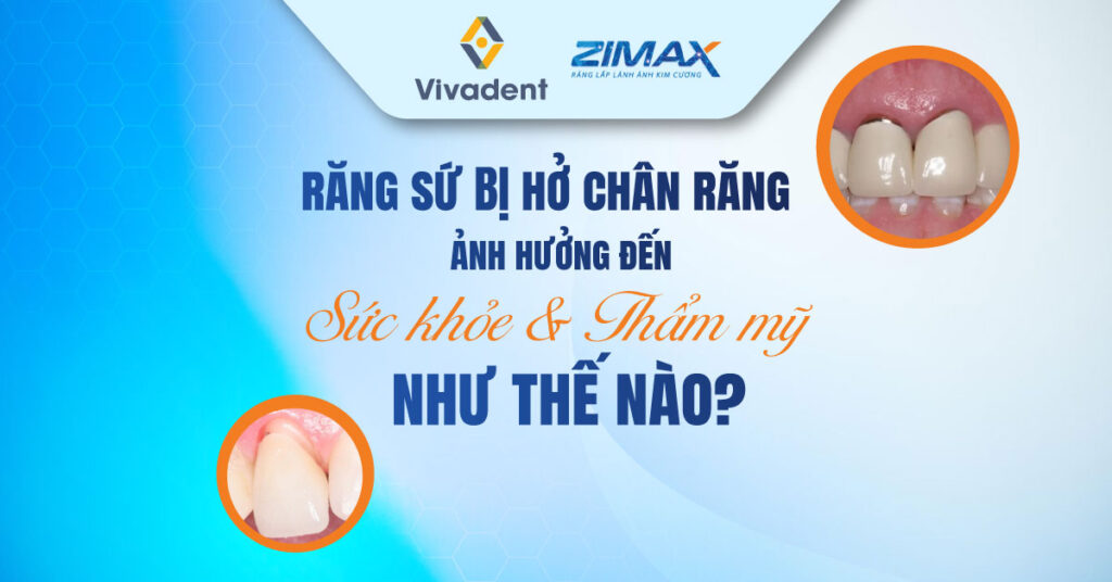 Răng sứ hở chân răng ảnh hưởng đến sức khỏe và thẩm mỹ thế nào