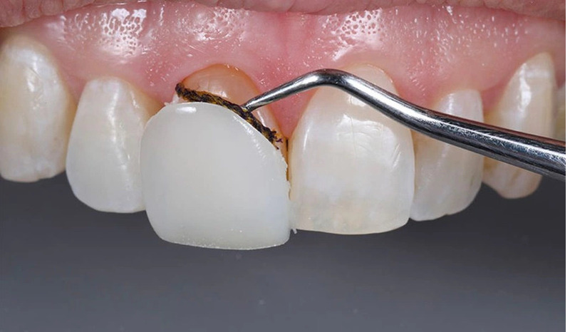 hức ăn dễ bị mắc vào kẽ hở ở phần chân răng