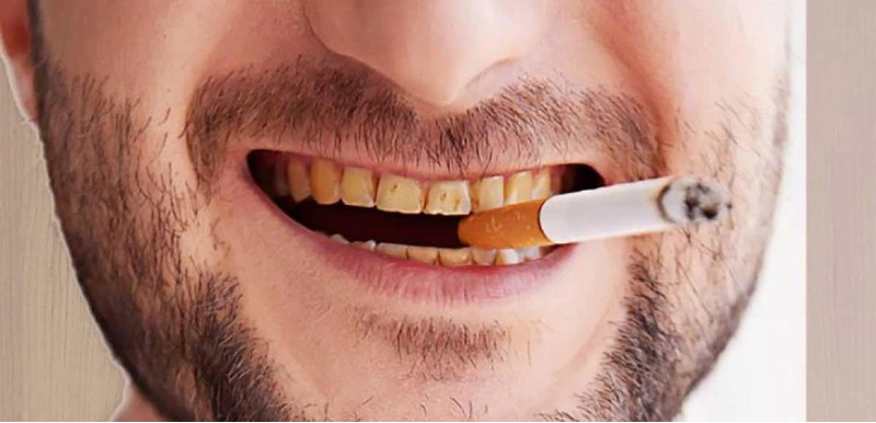 Thuốc lá là một trong những nguyên nhân khiến răng sứ bị xỉn màu, ố vàng