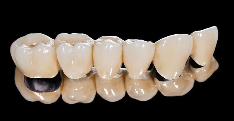Răng sứ kim loại thường có giá thành rẻ nhưng tính thẩm mỹ thấp